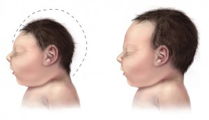 A side-by-side comparison of two babies, one with microcephaly.